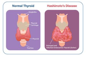 Hashimoto Thyroiditis